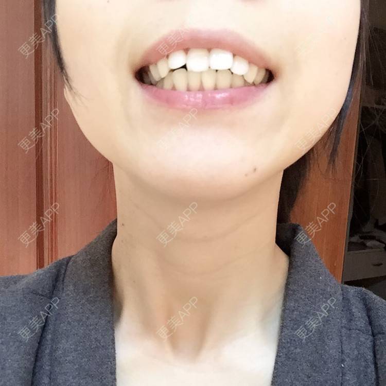 更美 - 吸脂祛眼袋+自体脂肪黑眼圈+自体脂肪泪沟+自体脂肪卧蚕+自体脂肪丰额头+自体脂肪丰下巴+太阳穴脂肪填充+龅牙+隐形矫正+胶原蛋白填充祛法令纹的日记 | 外切去眼袋 | 自体脂肪丰卧蚕 | 自体脂肪填充泪沟 | 自体脂肪淡化黑眼圈 | 自体脂肪垫下巴 | 自体脂肪丰太阳穴 | 自体脂肪丰额头 | 胶原蛋白改善法令纹 | 龅牙 | 苏州