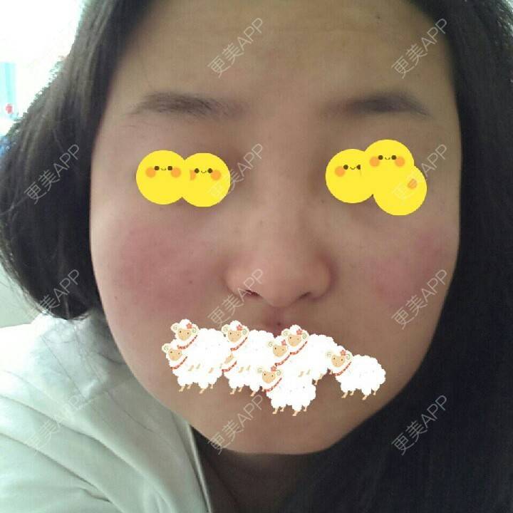 更美 - 自体脂肪丰下巴+自体脂肪丰额头+自体脂肪隆鼻 | 自体脂肪隆鼻 | 自体脂肪垫下巴 | 自体脂肪丰额头 | 西安