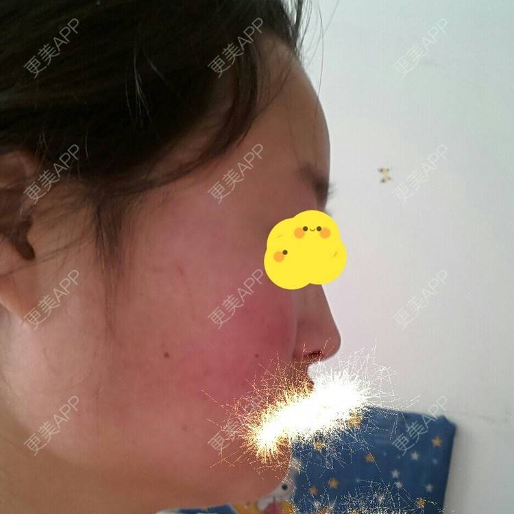 更美 - 自体脂肪丰下巴+自体脂肪丰额头+自体脂肪隆鼻 | 自体脂肪隆鼻 | 自体脂肪垫下巴 | 自体脂肪丰额头 | 西安