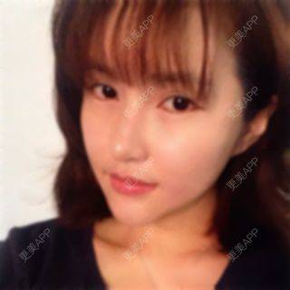 更美 - エイリ的全切双眼皮经验 | 全切双眼皮 | 埋线双眼皮 | 开外眼角 | 内切去眼袋 | 自体脂肪填充泪沟 | 切眉 | 自体脂肪淡化黑眼圈 | 除皱瘦脸 | 自体脂肪丰苹果肌 | 自体脂肪垫下巴 | 硅胶垫下巴 | 酒窝成形 | 自体脂肪丰面颊 | 自体脂肪丰额头 | 光子嫩肤 | 假体隆胸 | 硅胶隆鼻 | 厦门