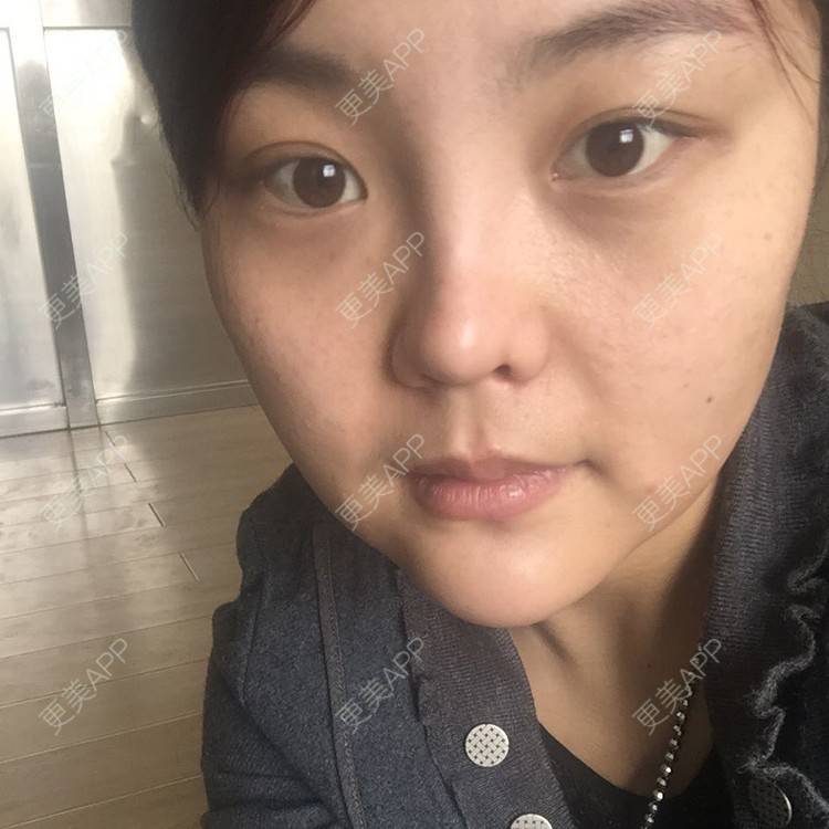 更美 - 硅胶垫下巴+瘦脸针+吸脂瘦脸的日记 | 除皱瘦脸 | 吸脂瘦脸 | 硅胶垫下巴 | 西宁