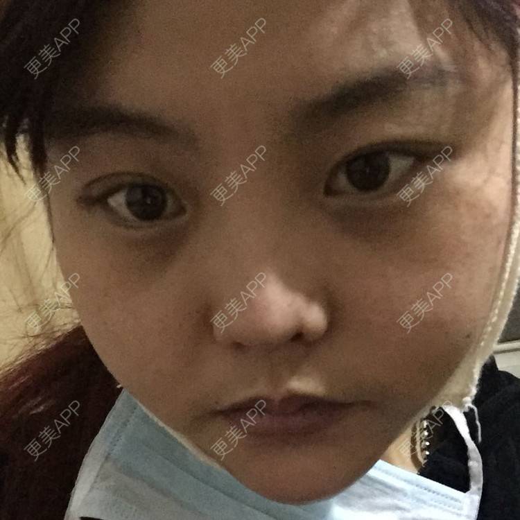 更美 - 硅胶垫下巴+瘦脸针+吸脂瘦脸的日记 | 除皱瘦脸 | 吸脂瘦脸 | 硅胶垫下巴 | 西宁