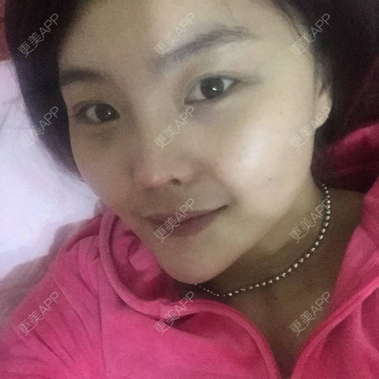 更美 - 硅胶垫下巴+瘦脸针+吸脂瘦脸的日记 | 除皱瘦脸 | 吸脂瘦脸 | 硅胶垫下巴 | 西宁