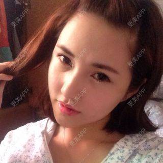 更美 - エイリ的全切双眼皮经验 | 全切双眼皮 | 埋线双眼皮 | 开外眼角 | 内切去眼袋 | 自体脂肪填充泪沟 | 切眉 | 自体脂肪淡化黑眼圈 | 除皱瘦脸 | 自体脂肪丰苹果肌 | 自体脂肪垫下巴 | 硅胶垫下巴 | 酒窝成形 | 自体脂肪丰面颊 | 自体脂肪丰额头 | 光子嫩肤 | 假体隆胸 | 硅胶隆鼻 | 厦门