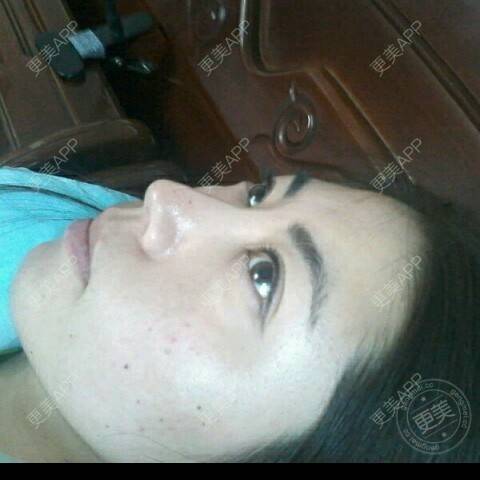 更美 - 更美用户53219695的自体脂肪填充泪沟经验 | 自体脂肪填充泪沟 | 自体脂肪丰苹果肌 | 自体脂肪垫下巴 | 自体脂肪丰额头 | 丹东