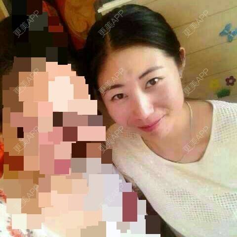 更美 - 自体脂肪泪沟+自体脂肪苹果肌+自体脂肪丰额头+自体脂肪丰下巴 | 自体脂肪填充泪沟 | 自体脂肪丰苹果肌 | 自体脂肪垫下巴 | 自体脂肪丰额头 | 丹东