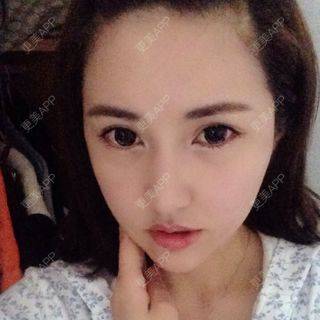 更美 - エイリ的全切双眼皮经验 | 全切双眼皮 | 埋线双眼皮 | 开外眼角 | 内切去眼袋 | 自体脂肪填充泪沟 | 切眉 | 自体脂肪淡化黑眼圈 | 除皱瘦脸 | 自体脂肪丰苹果肌 | 自体脂肪垫下巴 | 硅胶垫下巴 | 酒窝成形 | 自体脂肪丰面颊 | 自体脂肪丰额头 | 光子嫩肤 | 假体隆胸 | 硅胶隆鼻 | 厦门