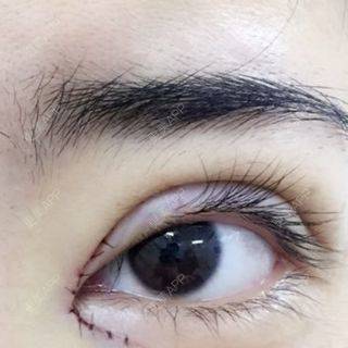 切开双眼皮开内眼角的日记