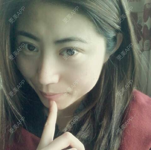 更美 - 自体脂肪泪沟+自体脂肪苹果肌+自体脂肪丰额头+自体脂肪丰下巴 | 自体脂肪填充泪沟 | 自体脂肪丰苹果肌 | 自体脂肪垫下巴 | 自体脂肪丰额头 | 丹东