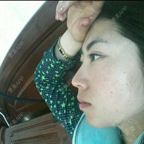 更美 - 更美用户53219695的自体脂肪填充泪沟经验 | 自体脂肪填充泪沟 | 自体脂肪丰苹果肌 | 自体脂肪垫下巴 | 自体脂肪丰额头 | 丹东