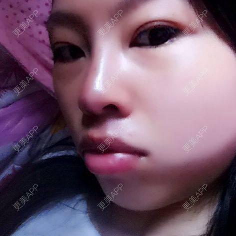 更美 - 朝天鼻矫正术+隆鼻改善短鼻的日记 | 朝天鼻矫正 | 广州