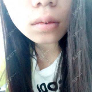 更美 - 厚唇改薄+唇珠唇弓的日记 | 厚唇改薄 | 常州
