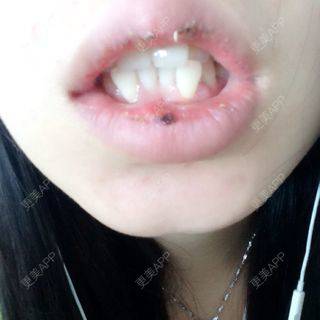更美 - 厚唇改薄+唇珠唇弓的日记 | 厚唇改薄 | 常州