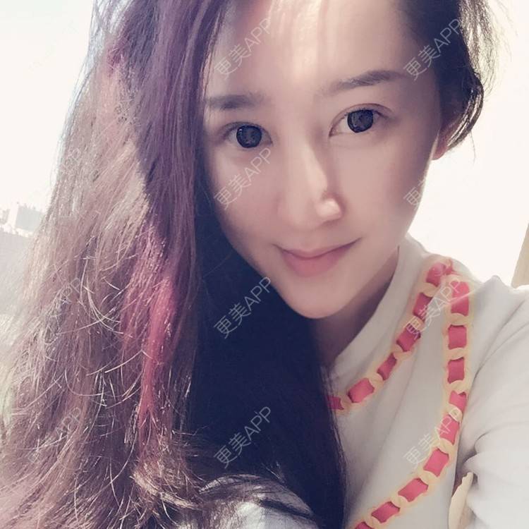 更美 - 埋线双眼皮+开内眼角+玻尿酸垫鼻基底+纹眉+牙齿矫正+牙齿稀疏+智齿的日记 | 埋线双眼皮 | 开内眼角 | 牙齿矫正 | 半永久纹眉 | 玻尿酸鼻基底 | 牙齿稀疏