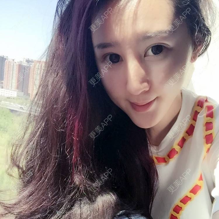 更美 - 埋线双眼皮+开内眼角+玻尿酸垫鼻基底+纹眉+牙齿矫正+牙齿稀疏+智齿的日记 | 埋线双眼皮 | 开内眼角 | 牙齿矫正 | 半永久纹眉 | 玻尿酸鼻基底 | 牙齿稀疏