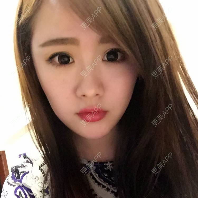 更美 - 玻尿酸丰下巴的日记 | 玻尿酸下巴 | 鞍山