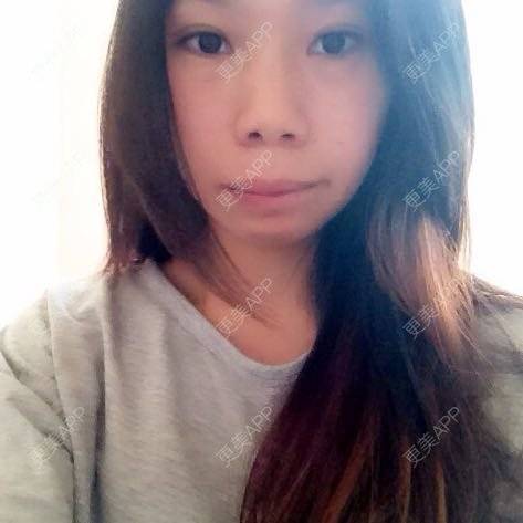 更美 - vivi_0316的牙齿矫正经验 | 牙齿矫正 | 牙列拥挤 | 拔牙 | 黔西南