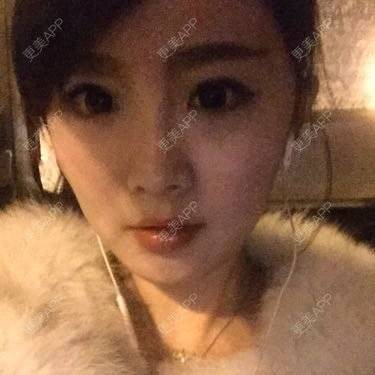 更美 - 玻尿酸丰下巴的日记 | 玻尿酸下巴 | 鞍山