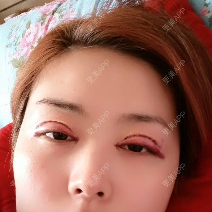 更美 - 好好好美的全切双眼皮经验 | 全切双眼皮 | 埋线双眼皮 | 开内眼角 | 眼皮下垂矫正 | 苏州 | 所长精选