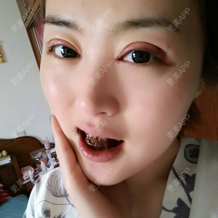 更美 - 好好好美的全切双眼皮经验 | 全切双眼皮 | 埋线双眼皮 | 开内眼角 | 眼皮下垂矫正 | 苏州 | 所长精选