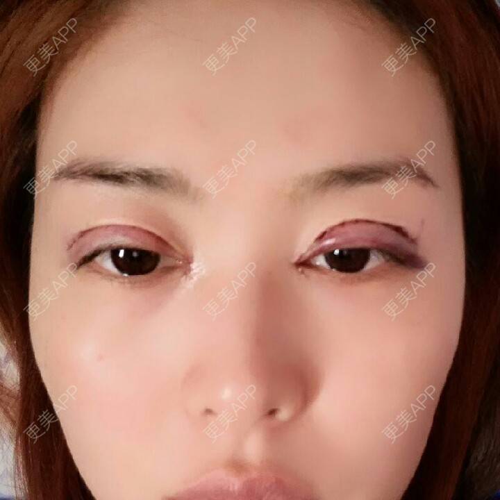 更美 - 切开双眼皮+开内眼角+上睑下垂+埋线双眼皮 | 全切双眼皮 | 埋线双眼皮 | 开内眼角 | 眼皮下垂矫正 | 苏州 | 所长精选