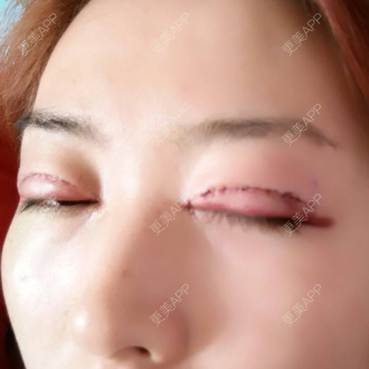 更美 - 好好好美的全切双眼皮经验 | 全切双眼皮 | 埋线双眼皮 | 开内眼角 | 眼皮下垂矫正 | 苏州 | 所长精选