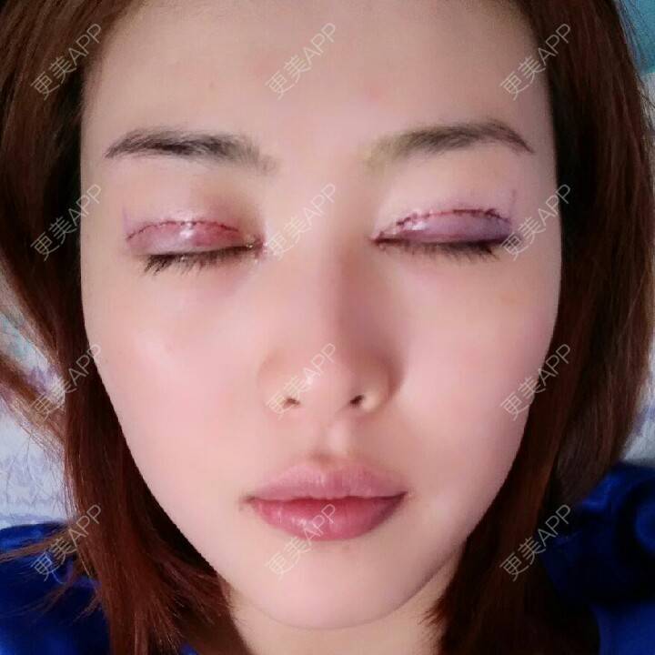 更美 - 切开双眼皮+开内眼角+上睑下垂+埋线双眼皮 | 全切双眼皮 | 埋线双眼皮 | 开内眼角 | 眼皮下垂矫正 | 苏州 | 所长精选