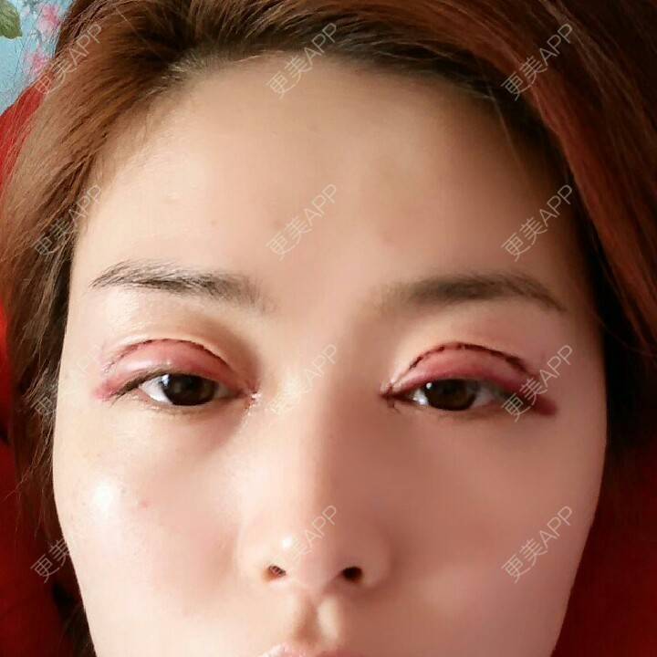 更美 - 好好好美的全切双眼皮经验 | 全切双眼皮 | 埋线双眼皮 | 开内眼角 | 眼皮下垂矫正 | 苏州 | 所长精选