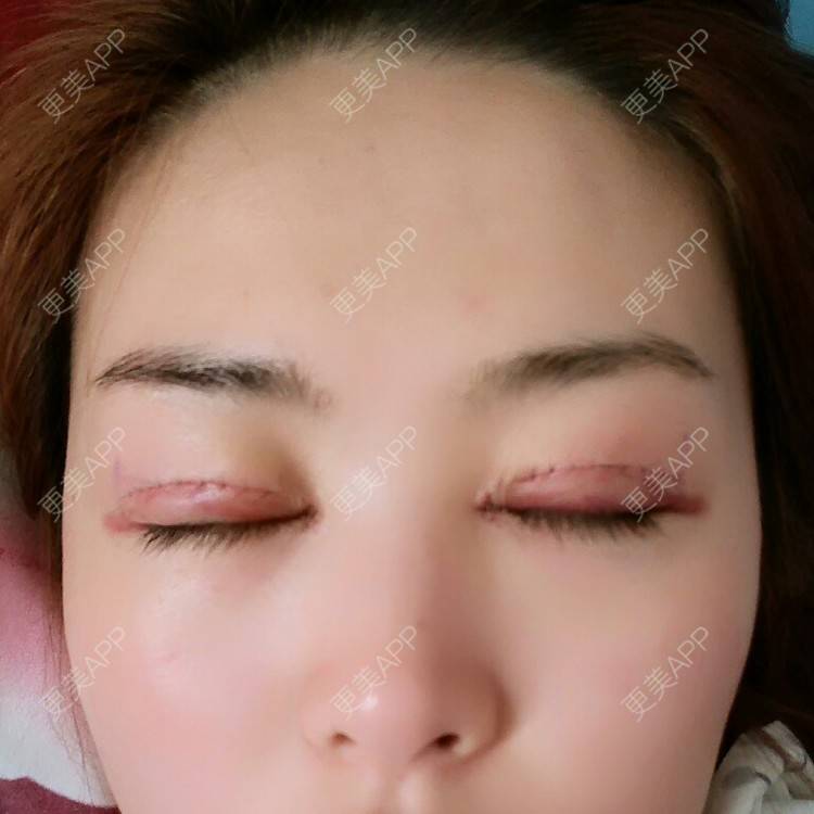 更美 - 好好好美的全切双眼皮经验 | 全切双眼皮 | 埋线双眼皮 | 开内眼角 | 眼皮下垂矫正 | 苏州 | 所长精选
