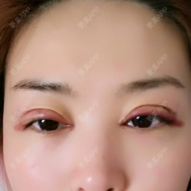 更美 - 好好好美的全切双眼皮经验 | 全切双眼皮 | 埋线双眼皮 | 开内眼角 | 眼皮下垂矫正 | 苏州 | 所长精选