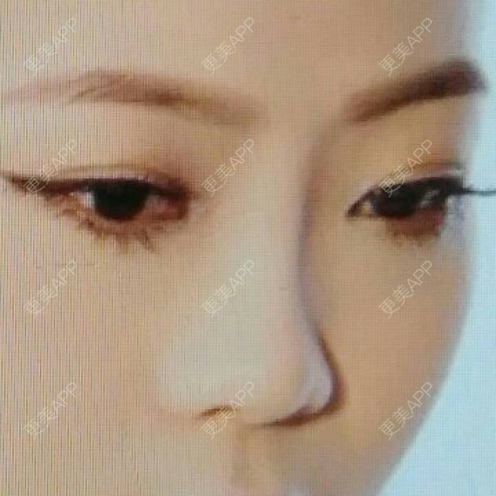更美 - 夏之沫于的经验 | 鼻部修复 | 金华
