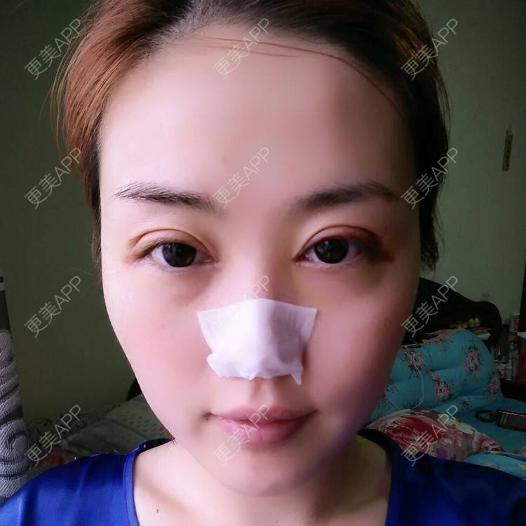 更美 - 好好好美的全切双眼皮经验 | 全切双眼皮 | 埋线双眼皮 | 开内眼角 | 眼皮下垂矫正 | 苏州 | 所长精选