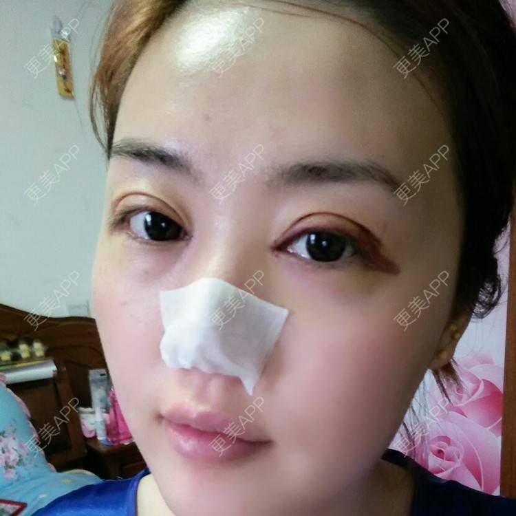 更美 - 好好好美的全切双眼皮经验 | 全切双眼皮 | 埋线双眼皮 | 开内眼角 | 眼皮下垂矫正 | 苏州 | 所长精选
