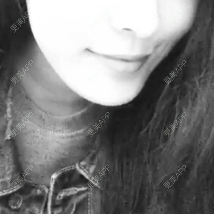 更美 - Amiee-zxh的硅胶垫下巴经验 | 硅胶垫下巴 | 北京