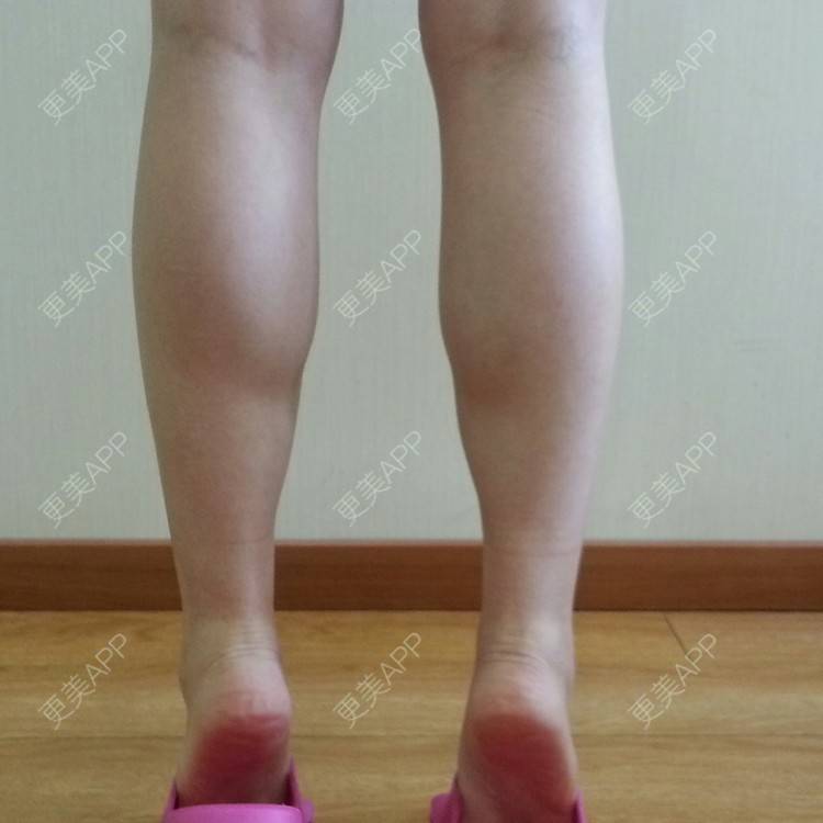 更美 - 肉毒素瘦小腿 果酸 | 瘦腿 | 果酸焕肤 | 北京 | 美购日记