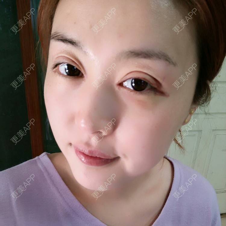 更美 - 好好好美的全切双眼皮经验 | 全切双眼皮 | 埋线双眼皮 | 开内眼角 | 眼皮下垂矫正 | 苏州 | 所长精选