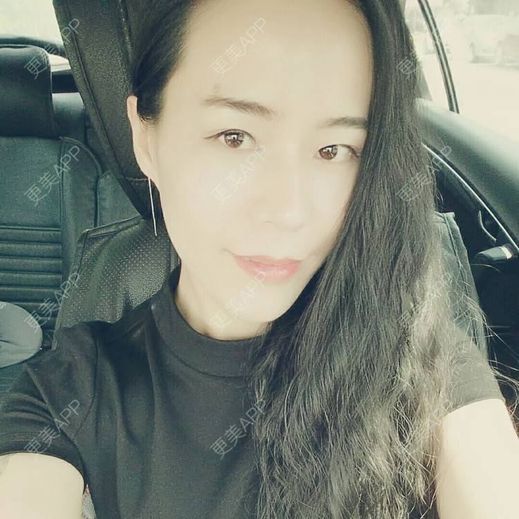 更美 - 自体脂肪丰额头+玻尿酸丰苹果肌+太阳穴脂肪填充 | 全切双眼皮 | 自体脂肪填充泪沟 | 自体脂肪丰苹果肌 | 自体脂肪垫下巴 | 自体脂肪丰面颊 | 自体脂肪丰太阳穴 | 自体脂肪丰额头 | 自体脂肪垫鼻基底 | 南充