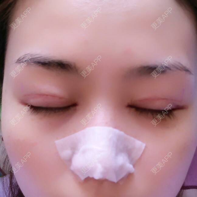 更美 - 好好好美的全切双眼皮经验 | 全切双眼皮 | 埋线双眼皮 | 开内眼角 | 眼皮下垂矫正 | 苏州 | 所长精选