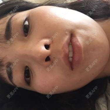 更美 - 15*******29的经验 | 颧骨颧弓 | 廊坊