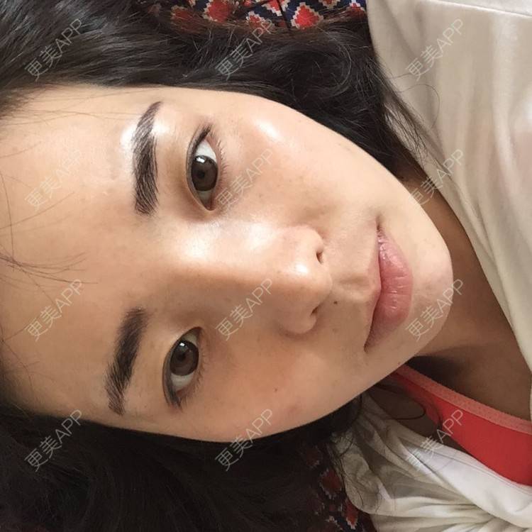 更美 - 15*******29的经验 | 颧骨颧弓 | 廊坊