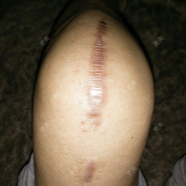 请问一下膝盖上的手术疤有什么办法可以祛掉啊有疤痕困扰夏天都不能穿