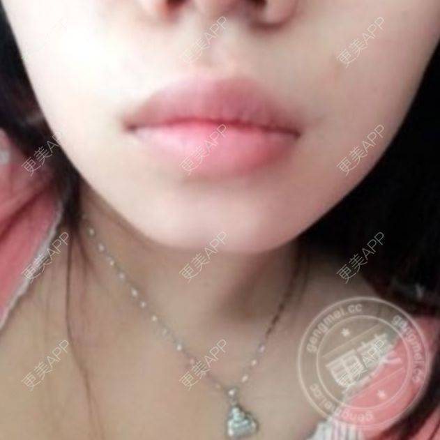 更美 - 厚唇改薄+唇珠唇弓的日记 | 厚唇改薄 | 常州