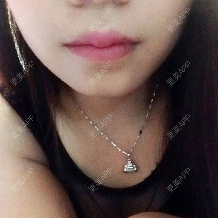 更美 - 厚唇改薄+唇珠唇弓的日记 | 厚唇改薄 | 常州