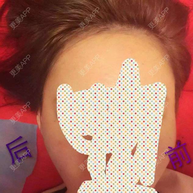 更美 - 玻尿酸丰太阳穴的日记 | 玻尿酸太阳穴 | 上海