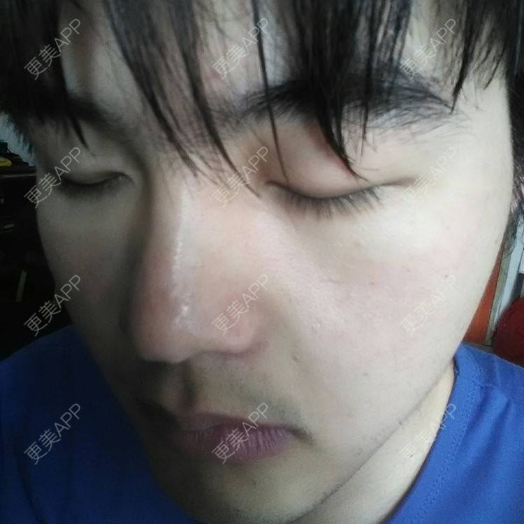 更美 - 开外眼角+微创双眼皮 | 定点双眼皮 | 开外眼角 | 黄冈