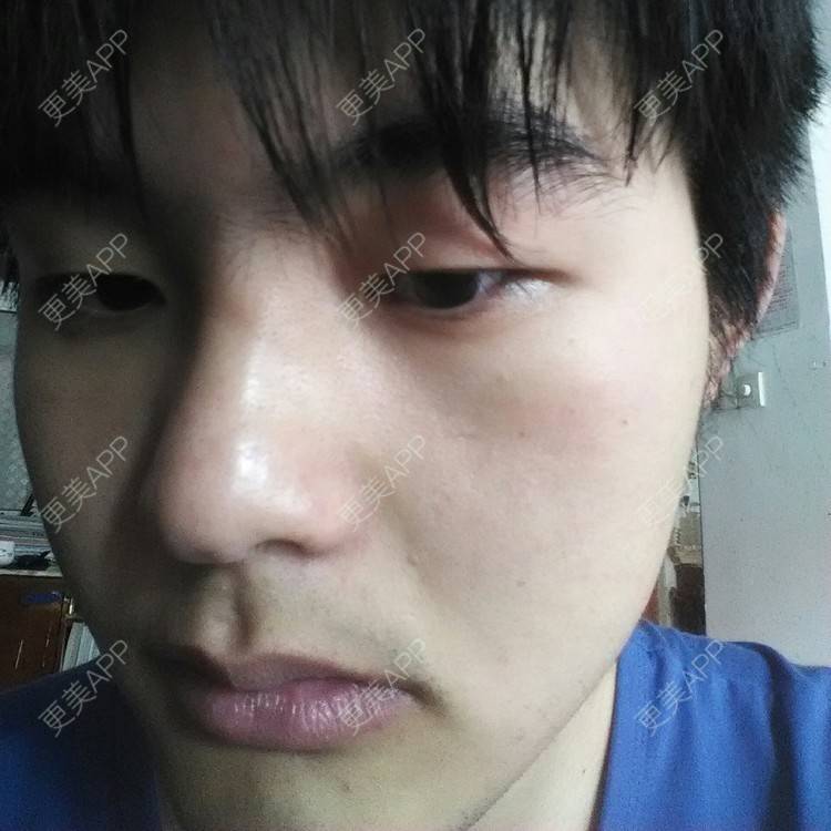 更美 - 开外眼角+微创双眼皮 | 定点双眼皮 | 开外眼角 | 黄冈