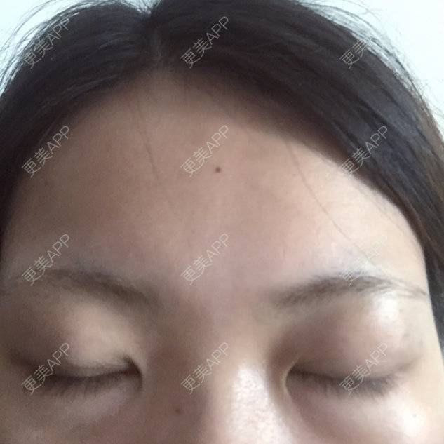 更美 - 切开双眼皮+开内眼角的日记 | 全切双眼皮 | 开内眼角 | 娄底