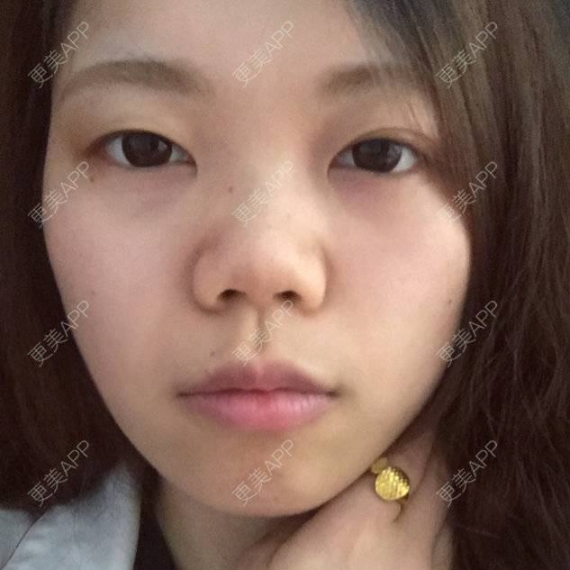 更美 - 切开双眼皮+开内眼角的日记 | 全切双眼皮 | 开内眼角 | 娄底