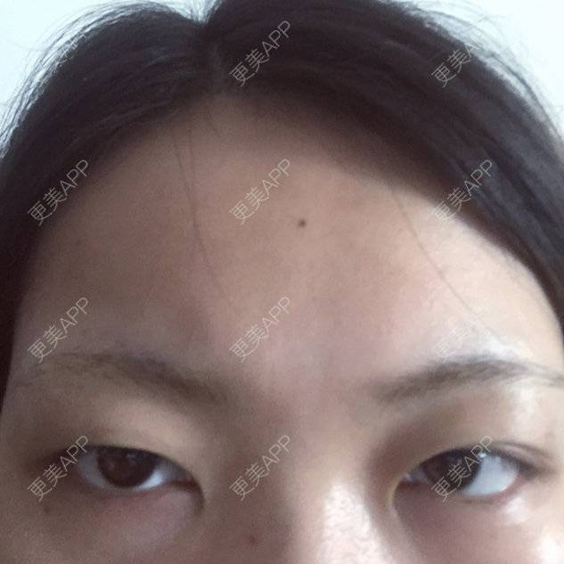 更美 - 切开双眼皮+开内眼角的日记 | 全切双眼皮 | 开内眼角 | 娄底