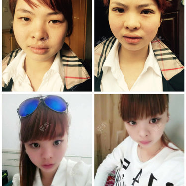 术后62天过去医院:合肥塑美医生:周小影#合肥2015-03-23定点双眼皮